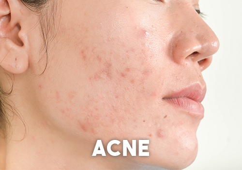 Acne Acne