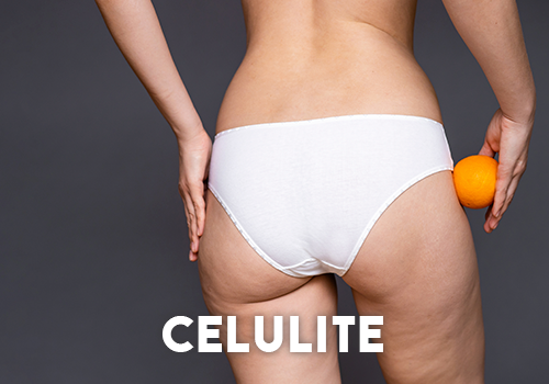 Celulite Celulite