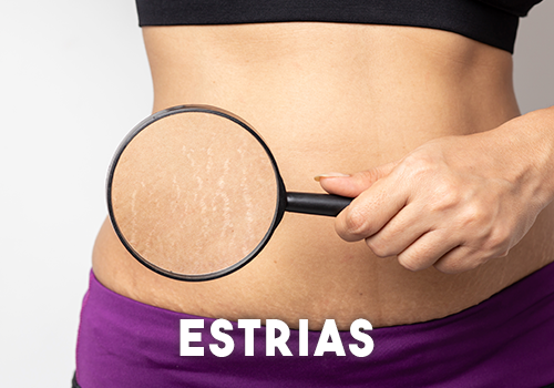 Estrias Estrias