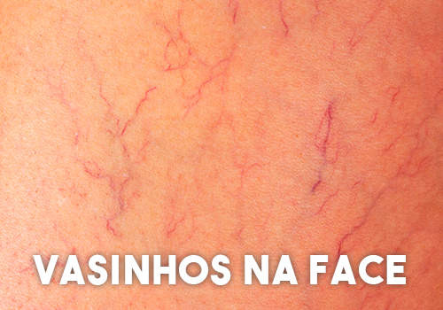 Vasinhos-na-Face Vasinhos-na-Face