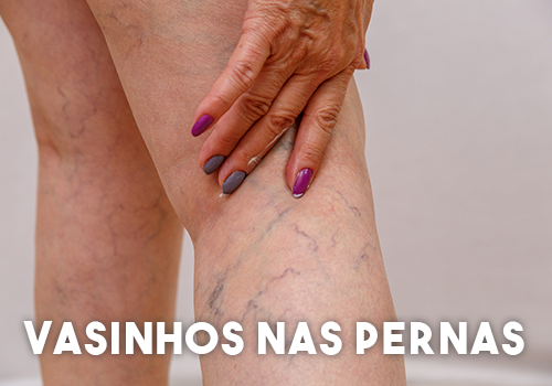 Vasinhos-nas-Pernas Vasinhos-nas-Pernas