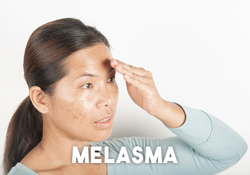 Melasma Melasma