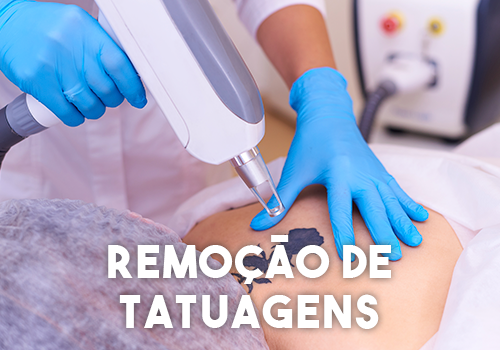 Remoção-de-Tatuagens Remoção-de-Tatuagens
